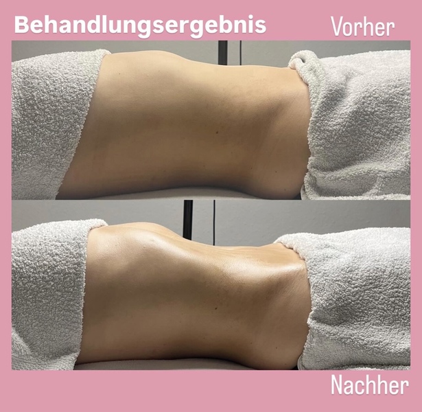 Brasilianische Lymphdrainage 