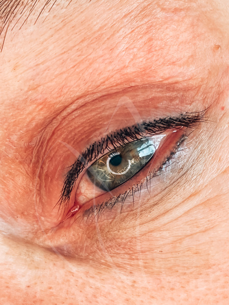 Wimpernkranzverdichtung oben und unten