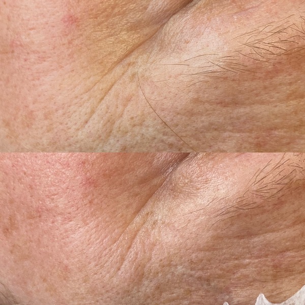 Faltenreduktion durch Microneedling