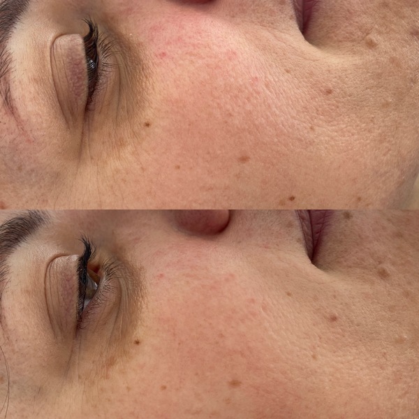 Ebenmäßigere Haut nach 1. Microneedling Anwendung