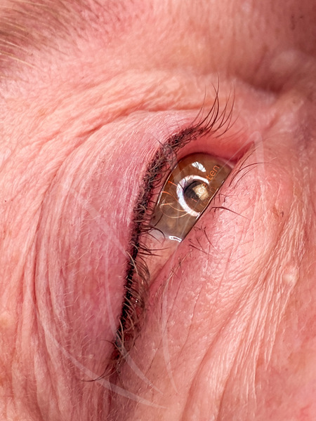 Verstärkte Wimpernkranzverdichtung