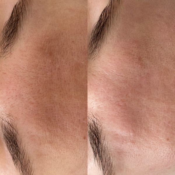 Porenverfeinerung nach 1. Microneedling Anwendung