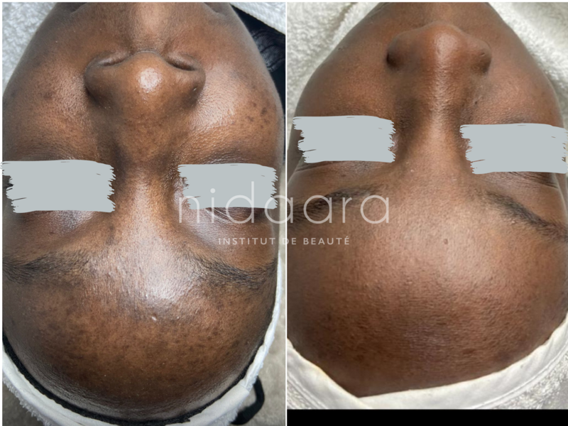 Après 3 séances de peeling TCA