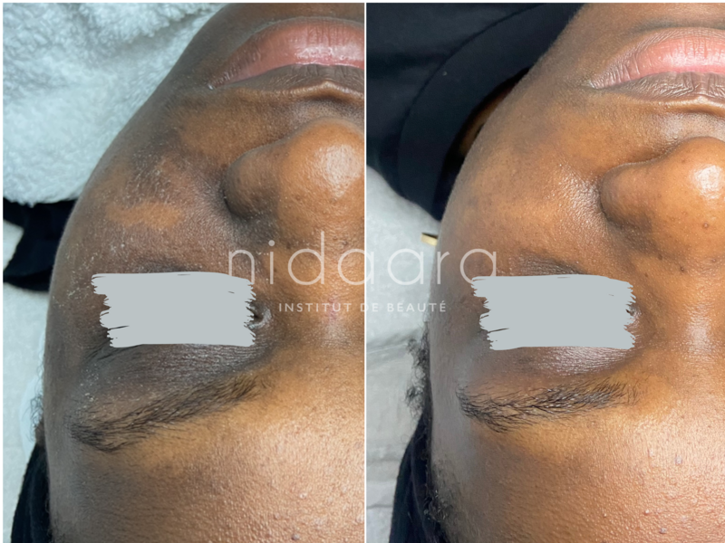 Après un hydraskin, un soin hydratant & apaisant et un microneedling