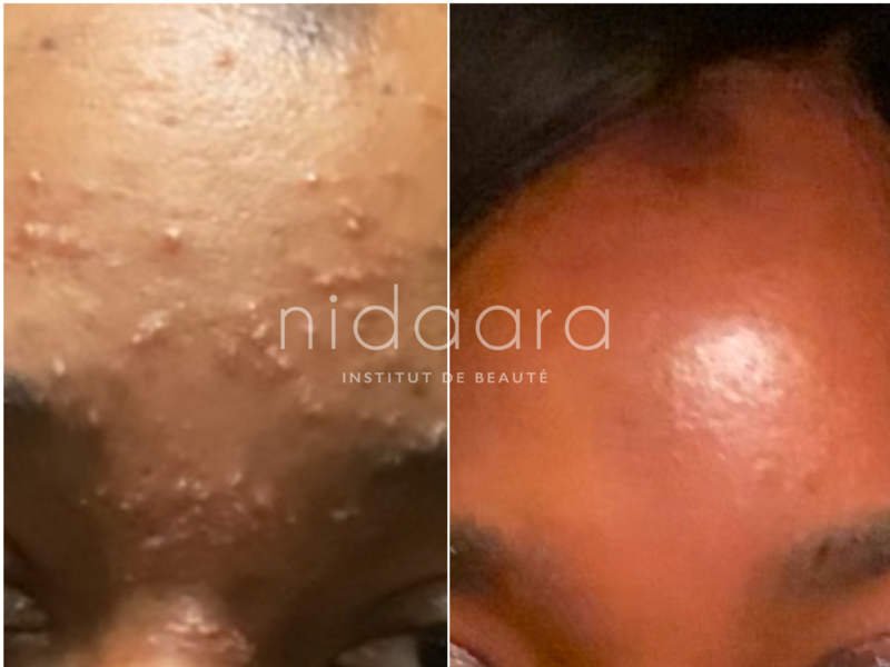 Après 2 peeling TCA et une routine personnalisée