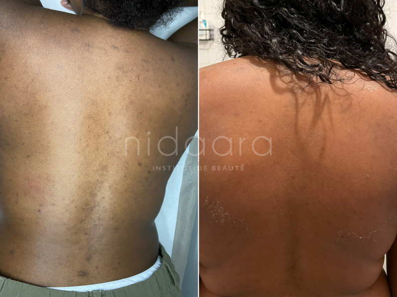 Après une séance de peeling aux algues