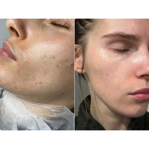 Après une séance de peeling aux algues